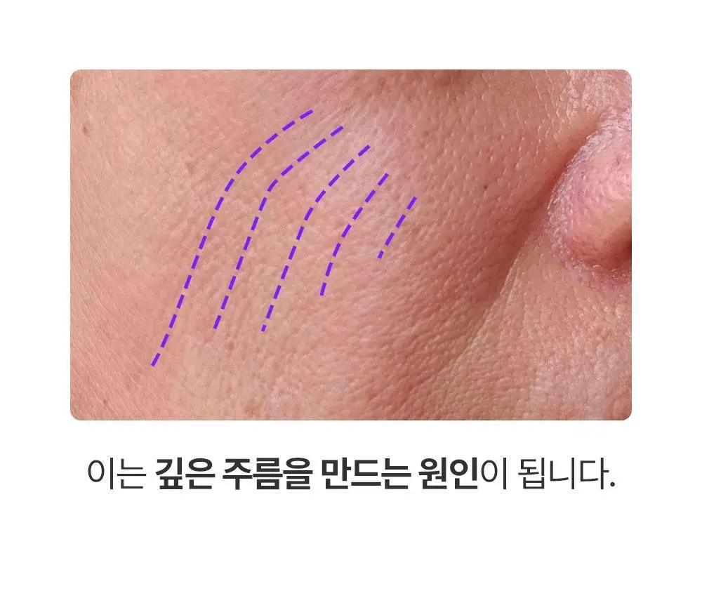 [모공임상] 프랭클리 모공축소 클로저 세럼 30ml 앰플 상세페이지 13
